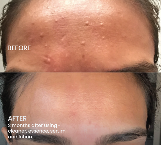 Image of Plantkos Phyto Exfoliating Cleanser before and after helps control blemishes